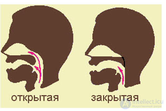 Ринолалия и гнусавость, Гиперназальная речь