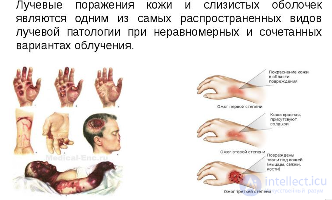 Лучевая болезнь виды, признаки, причины