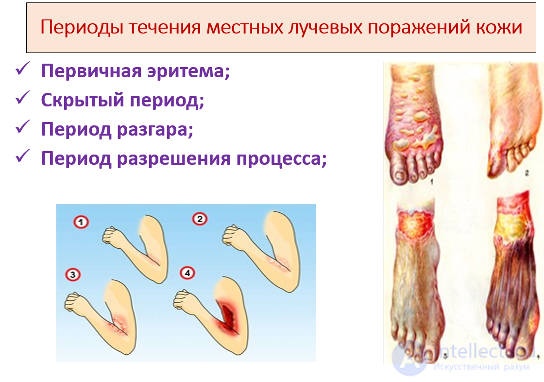 Лучевая болезнь виды, признаки, причины