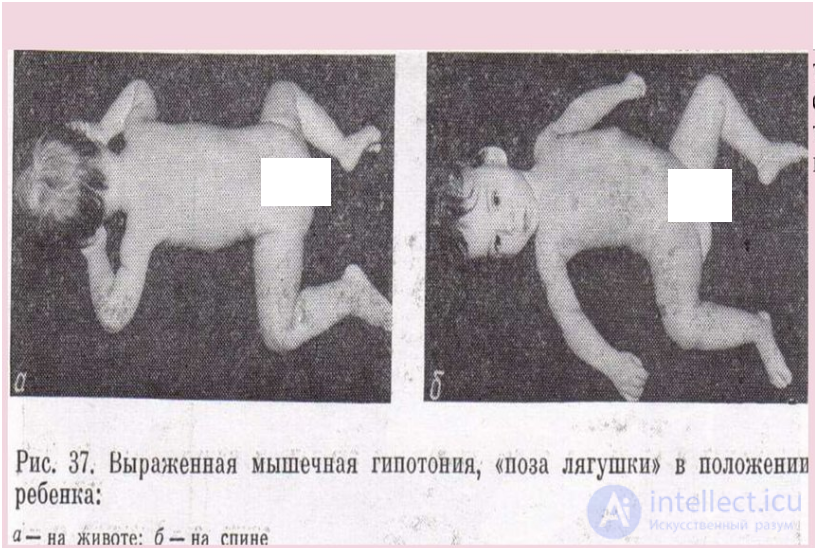 Перинатальная патология нервной системы.