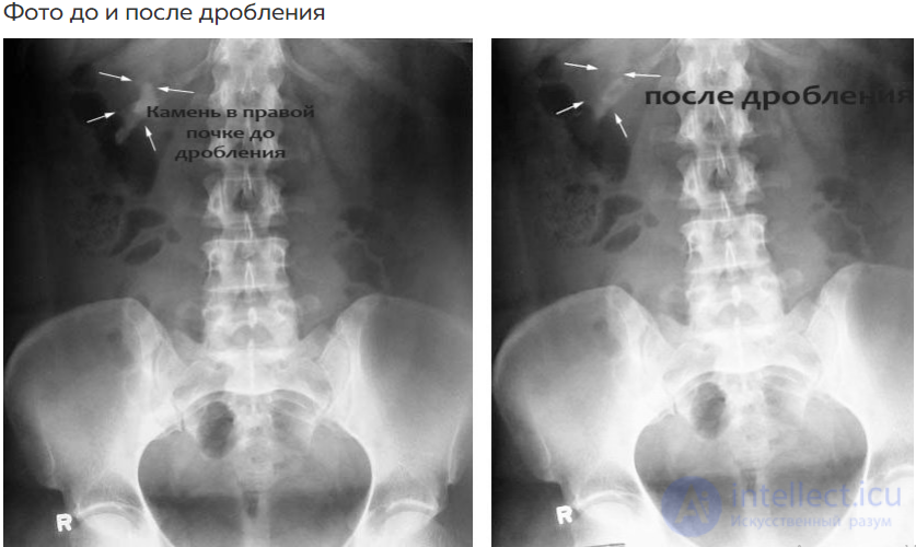 Почка после дробления камня. Камни в почках (конкременты). Дробление почечных камней. Мочекаменная болезнь рентген. Камень мочеточника на рентгенограмме.