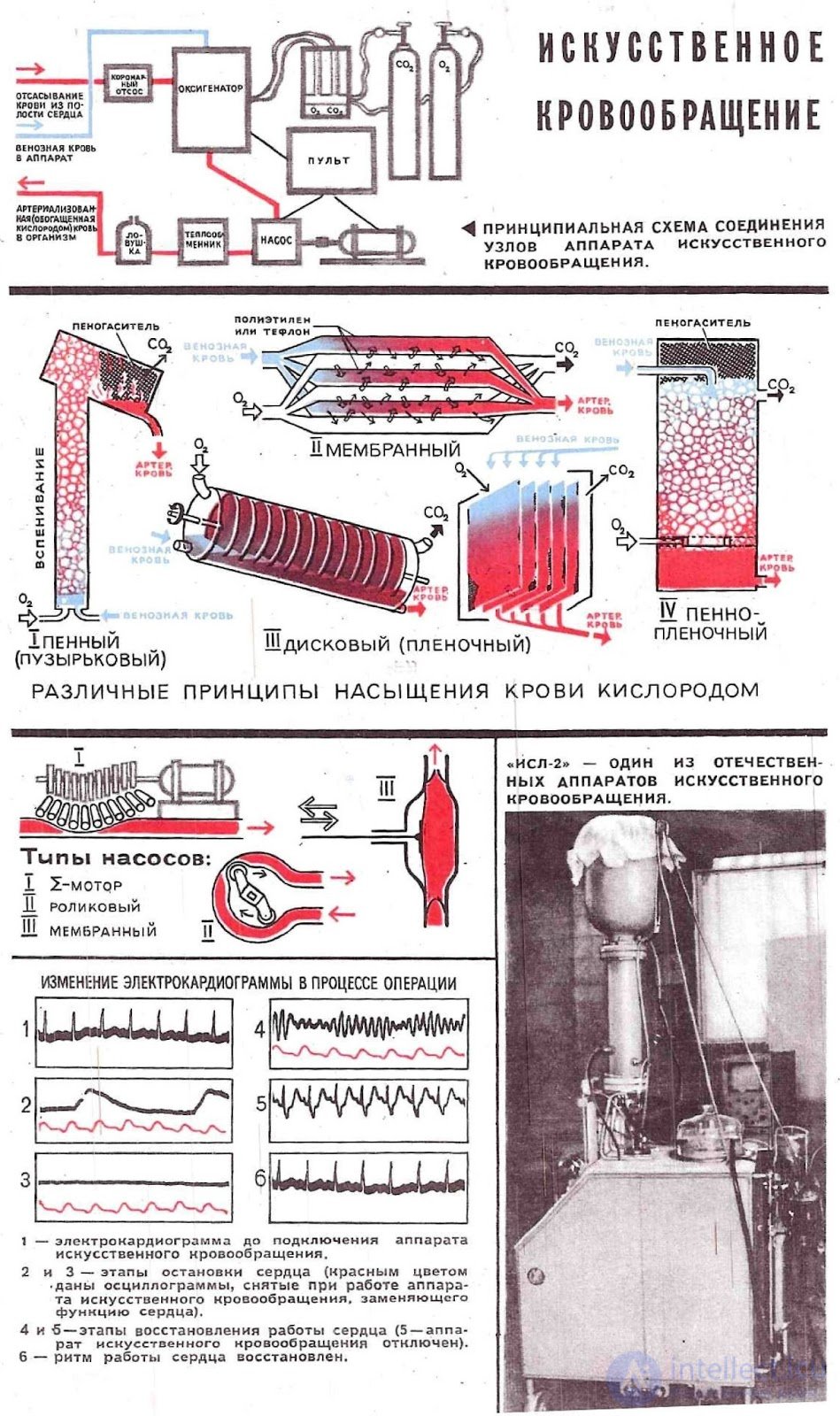 Аппаратура для поддержки кровообращения, искусственное сердце