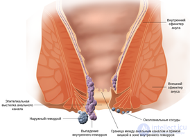 геморрой