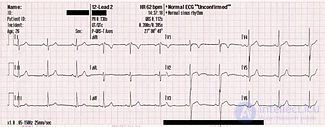 электрокардиография