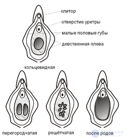 гименопластика