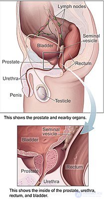 простатит